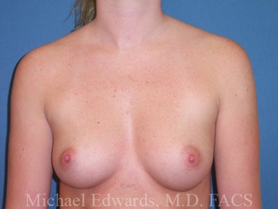Breast-Implants-before-88338.jpg